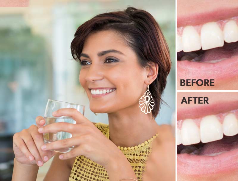 Woman smiling before and after enamel contouring