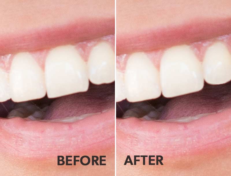 Enamel contouring before and after