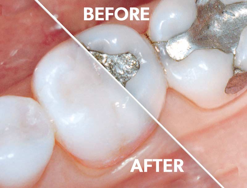 Porcelain fillings before and after